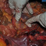 Autopsy of stabbed girl