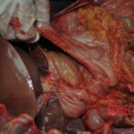 Autopsy of stabbed girl