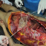 Autopsy of stabbed girl