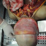 Autopsy of stabbed girl