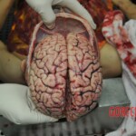 Autopsy of stabbed girl