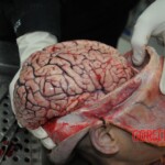 Autopsy of stabbed girl