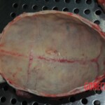 Autopsy of stabbed girl