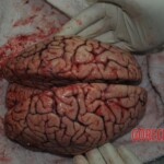 Autopsy of stabbed girl