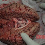 Autopsy of stabbed girl