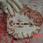 Autopsy of stabbed girl