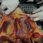 Autopsy of stabbed girl