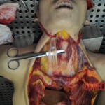 Autopsy of stabbed girl