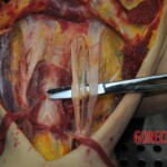 Autopsy of stabbed girl