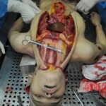 Autopsy of stabbed girl