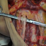 Autopsy of stabbed girl