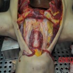 Autopsy of stabbed girl