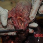 Autopsy of stabbed girl