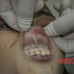 Autopsy of stabbed girl