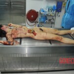 Autopsy of stabbed girl