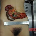 Autopsy of stabbed girl