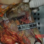 Autopsy of stabbed girl