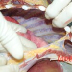 Autopsy of young girl