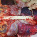 Autopsy of young girl