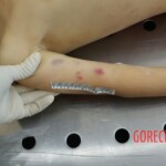 Autopsy of young girl