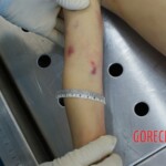 Autopsy of young girl