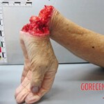 Amputated hand