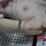 Autopsy of young woman