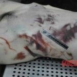 Autopsy of young woman