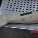 Autopsy of young woman