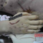 Autopsy of young woman