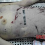 Autopsy of young woman