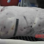 Autopsy of young woman