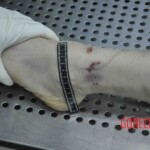 Autopsy of young woman