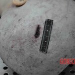 Autopsy of young woman