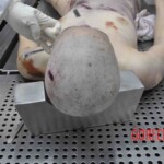 Autopsy of young woman