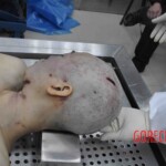 Autopsy of young woman