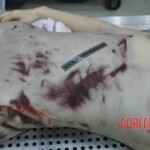 Autopsy of young woman