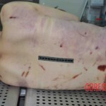 Autopsy of young woman