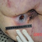 Autopsy of young woman