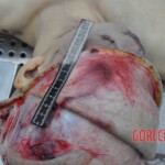 Autopsy of young woman