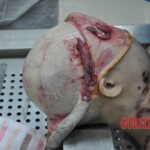 Autopsy of young woman