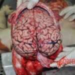 Autopsy of young woman