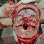 Autopsy of young woman