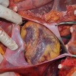 Autopsy of young woman