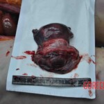 Autopsy of young woman