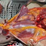 Autopsy of young woman