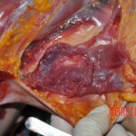 Autopsy of young woman