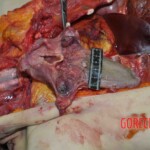 Autopsy of young woman