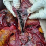 Autopsy of young woman