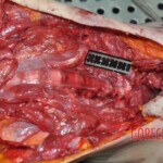 Autopsy of young woman